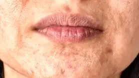 چه کنید در هوای گرما جوش نزنید ؟ + 16 روش 